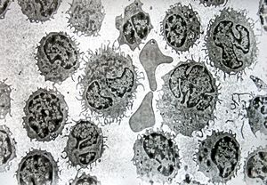 F,59y. | blood - hairy cell leukemia